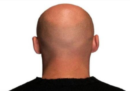 يحدث في باكستان.. زرع الشعر يعيد للرجال “الصُلع” “شرفهم” الضائع