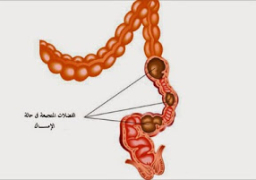 هام لصحتك.. علاج بسيط جداً لتنظيف القولون من السموم