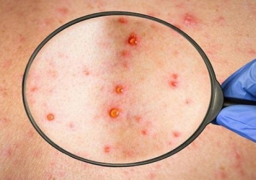 ارتفاع الإصابات بجدري القردة في المملكة المتحدة إلى 1735 حالة