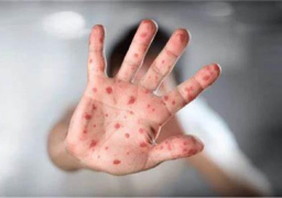 اليابان تسجل ثاني إصابة بجدري القرود