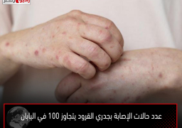 عدد حالات الإصابة بجدري القرود يتجاوز 100 في اليابان